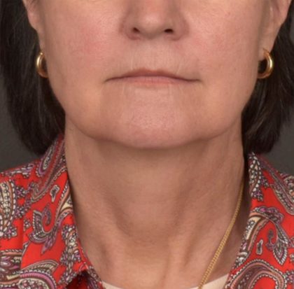 Neck Lift Before & After Patient #3962
