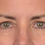 Blepharoplasty Before & After Patient #3963
