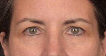 Blepharoplasty Before & After Patient #3963