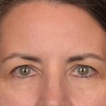 Brow Lift Before & After Patient #3964