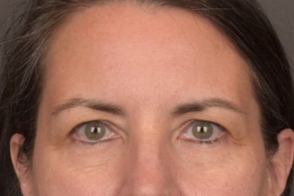 Brow Lift Before & After Patient #3964