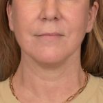 Neck Lift Before & After Patient #3915