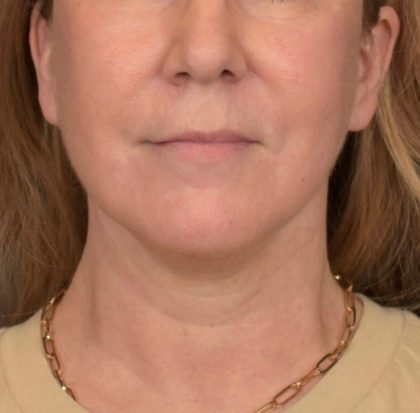 Neck Lift Before & After Patient #3915