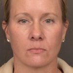 Facelift Before & After Patient #4014