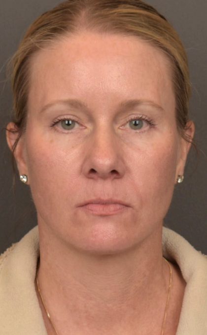 Facelift Before & After Patient #4014