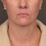 Neck Lift Before & After Patient #4015
