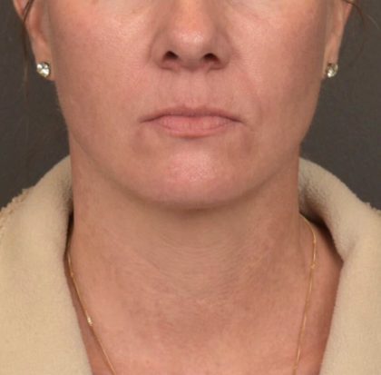 Neck Lift Before & After Patient #4015