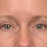 Blepharoplasty Before & After Patient #4016