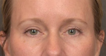 Blepharoplasty Before & After Patient #4016