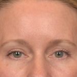 Brow Lift Before & After Patient #4017