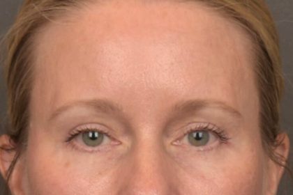 Brow Lift Before & After Patient #4017