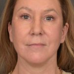 Facelift Before & After Patient #3914