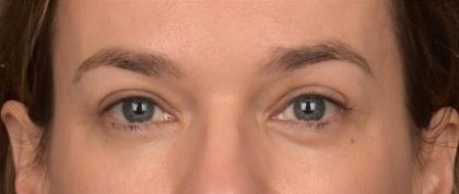 Blepharoplasty Before & After Patient #4059