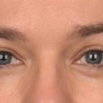 Facial Fat Grafting Before & After Patient #4060