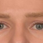 Blepharoplasty Before & After Patient #4074