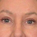 Blepharoplasty Before & After Patient #3916