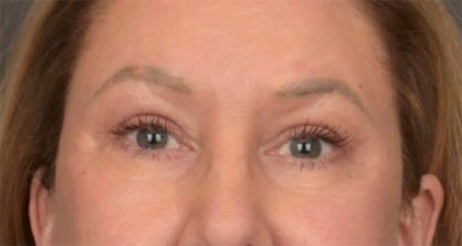 Blepharoplasty Before & After Patient #3916