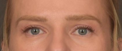 Facial Fat Grafting Before & After Patient #4073