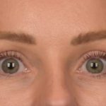 Blepharoplasty Before & After Patient #4094