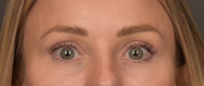 Blepharoplasty Before & After Patient #4094