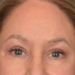 Brow Lift Before & After Patient #3917