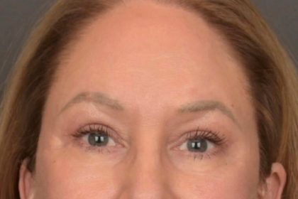 Brow Lift Before & After Patient #3917