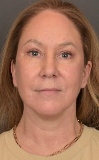 Facial Fat Grafting Before & After Patient #3918