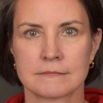 Facelift Before & After Patient #3961