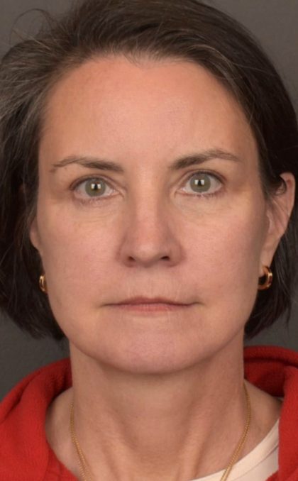 Facelift Before & After Patient #3961