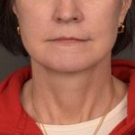 Neck Lift Before & After Patient #3962