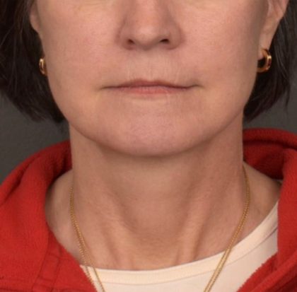 Neck Lift Before & After Patient #3962