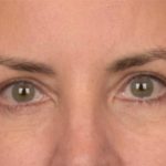 Blepharoplasty Before & After Patient #3963