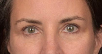Blepharoplasty Before & After Patient #3963