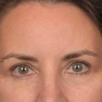 Brow Lift Before & After Patient #3964