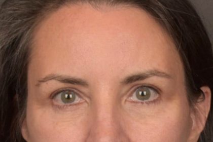 Brow Lift Before & After Patient #3964