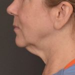 Neck Lift Before & After Patient #3915