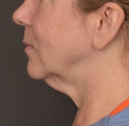 Neck Lift Before & After Patient #3915
