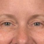 Blepharoplasty Before & After Patient #4016