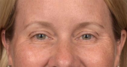 Blepharoplasty Before & After Patient #4016