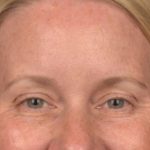 Brow Lift Before & After Patient #4017