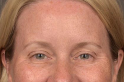 Brow Lift Before & After Patient #4017