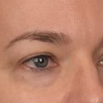 Blepharoplasty Before & After Patient #4059
