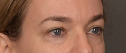 Blepharoplasty Before & After Patient #4059