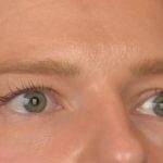 Blepharoplasty Before & After Patient #4074