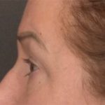 Blepharoplasty Before & After Patient #3916