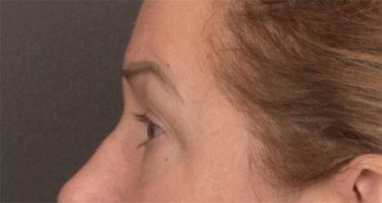 Blepharoplasty Before & After Patient #3916