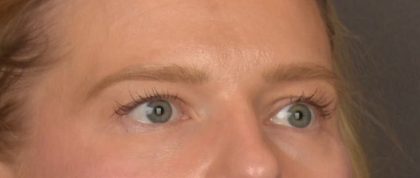Brow Lift Before & After Patient #4075