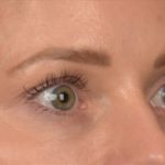 Blepharoplasty Before & After Patient #4094