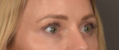 Facial Fat Grafting Before & After Patient #4096