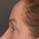 Brow Lift Before & After Patient #3917